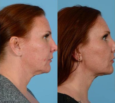 Case 10202 - Woman treated with Ultherapy