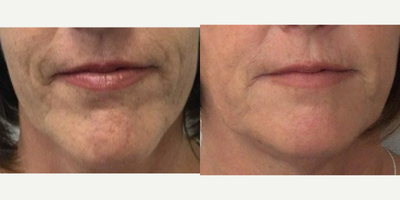 Case 10204 - 55-64 year old woman treated with Ultherapy