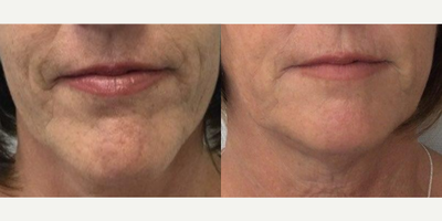 Case 10205 - 55-64 year old woman treated with Ultherapy