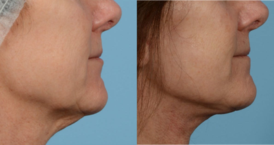 Case 10206 - Woman treated with Ultherapy