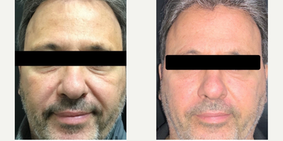 Case 10207 - 55-64 year old man treated with Ultherapy, Belotero, Dermal Fillers, Restylane, Skin Tightening
