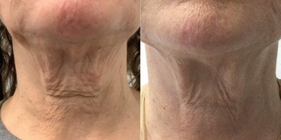 Case 10208 - 65-74 year old woman treated with Ultherapy