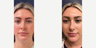 Case 10210 - 25-34 year old woman treated with Ultherapy