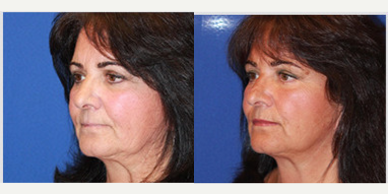 Case 10212 - 61 year old woman treated with Ultherapy