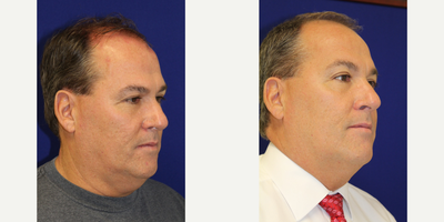 Case 10213 - 55-64 year old man treated with Ultherapy