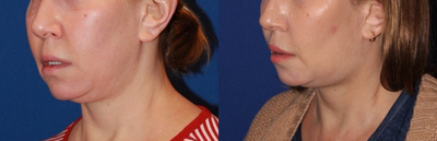 Case 10214 - 45-54 year old woman treated with Ultherapy