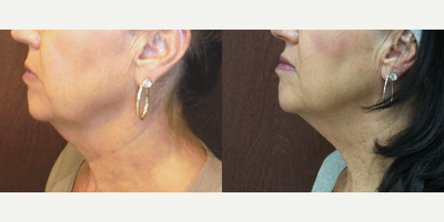 Case 10216 - 65 year old woman treated with Ultherapy