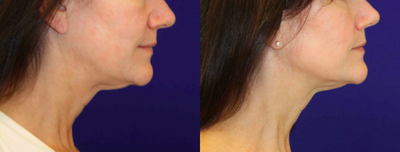 Case 10217 - 53  year old woman treated with Ultherapy-full face and neck treatment