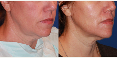 Case 10218 - 50 year old woman treated with Ultherapy