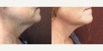 Case 10219 - 59 year old woman treated with Ultherapy