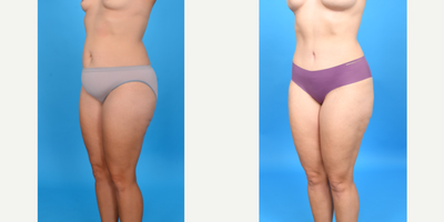 Case 1022 - 35-44 year old woman treated with Abdominal Etching, Diastasis Recti Repair, Drainless Tummy Tuck, Liposculpture, Liposuction, M