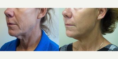 Case 10220 - 59 year old woman treated with Ultherapy