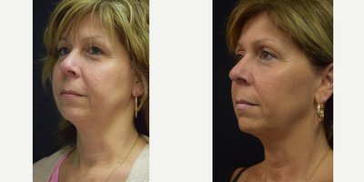 Case 10221 - 55-64 year old woman treated with Ultherapy