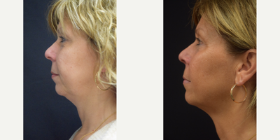 Case 10222 - 55-64 year old woman treated with Ultherapy