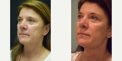 Case 10223 - 55-64 year old woman treated with Ultherapy