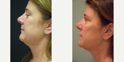 Case 10224 - 55-64 year old woman treated with Ultherapy