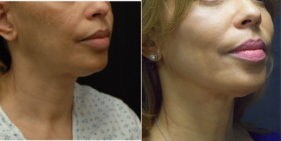 Case 10225 - 55-64 year old woman treated with Ultherapy