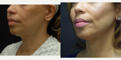 Case 10226 - 55-64 year old woman treated with Ultherapy