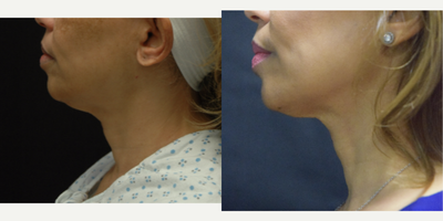 Case 10227 - 55-64 year old woman treated with Ultherapy