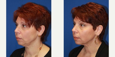 Case 10228 - 56 year old woman treated with Ultherapy