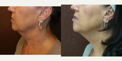 Case 10229 - 55-64 year old woman treated with Ultherapy