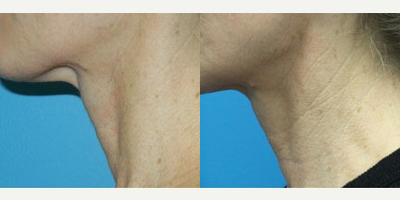 Case 10230 - 46 year old woman treated with Ultherapy