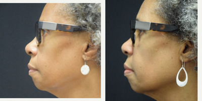 Case 10231 - 65-74 year old woman treated with Ultherapy