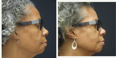 Case 10232 - 65-74 year old woman treated with Ultherapy
