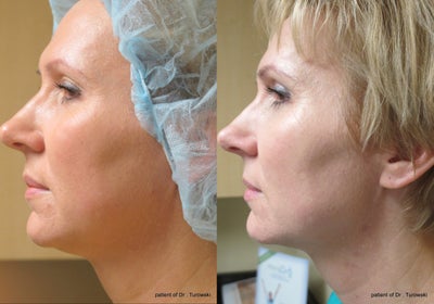 Case 10233 - Ultherapy neck lift