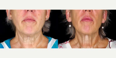 Case 10241 - 60 year old woman treated with Ultherapy to lower face and neck.