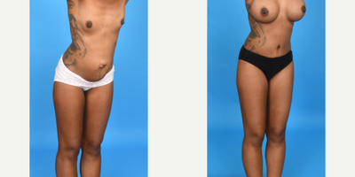 Case 1025 - 45-54 year old woman treated with Abdominal Etching, Tummy Tuck, Mini Tummy Tuck, Drainless Tummy Tuck, Vaser Liposuction, Mommy