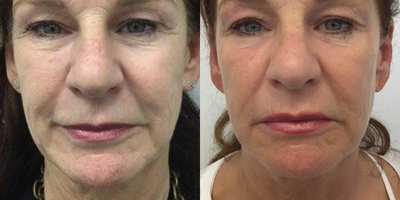 Case 10250 - 55-64 year old woman treated with Ultherapy