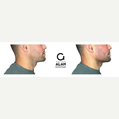 Case 10251 - 25-34 year old man treated with Ultherapy, Dermal Fillers, Radiesse