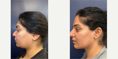 Case 10255 - Woman treated with Ultherapy