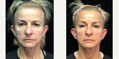 Case 10256 - 45-54 year old woman treated with Ultherapy