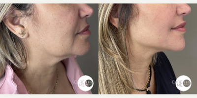 Case 10258 - 35-44 year old woman treated with Ultherapy