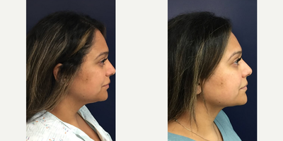 Case 10259 - 39 year old woman treated with Liposuction, Ultherapy