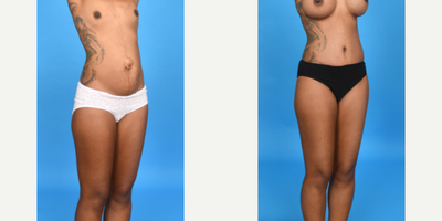 Case 1026 - 45-54 year old woman treated with Abdominal Etching, Tummy Tuck, Mini Tummy Tuck, Drainless Tummy Tuck, Vaser Liposuction, Mommy