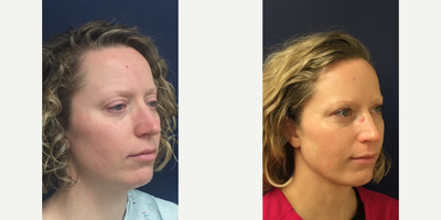 Case 10260 - 35-44 year old woman treated with FaceTite, Ultherapy