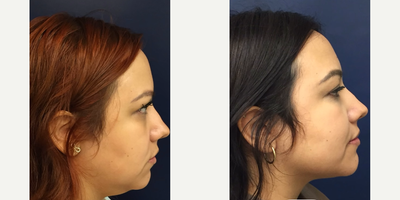 Case 10269 - Woman treated with Liposuction, Ultherapy