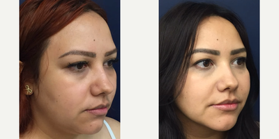 Case 10270 - Woman treated with Liposuction, Ultherapy