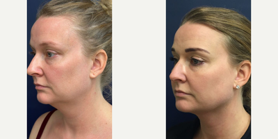 Case 10271 - Woman treated with Liposuction, Ultherapy