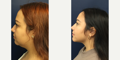 Case 10272 - Woman treated with Liposuction, Ultherapy