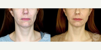 Case 10273 - 37 year old woman treated with Ultherapy to lower face and neck.