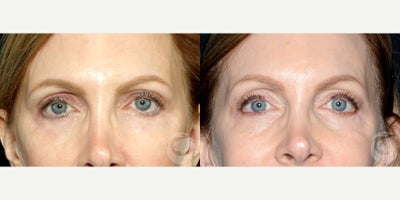 Case 10274 - 53 year old woman treated with Ultherapy to periorbital.