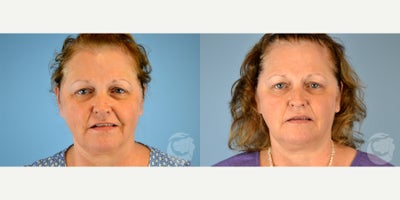 Case 10275 - 57 year old woman treated with Ultherapy to face and neck.