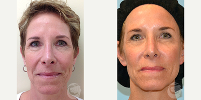 Case 10276 - 41 year old woman treated with Ultherapy to full face
