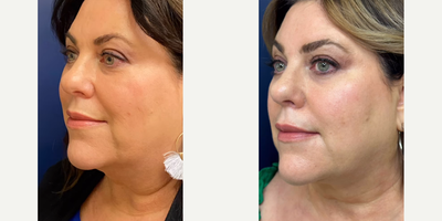 Case 10278 - Woman treated with Liposuction, Ultherapy, Morpheus8, Voluma