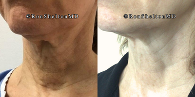 Case 10279 - 65-74 year old woman treated with Ultherapy, Sofwave, Neck Lift, Skin Tightening