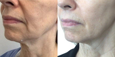 Case 10280 - 65-74 year old woman treated with Sofwave, Ultherapy, Skin Tightening